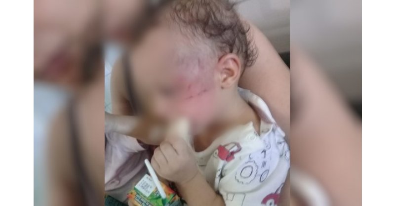 Bebê de 11 meses dá entrada em hospital com lesões graves e fratura no fêmur em SC; padrasto é preso