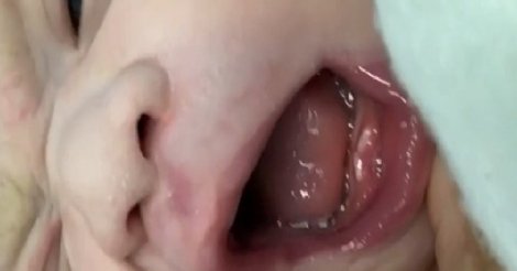 Bebê nasce com dois dentes e passa por cirurgia aos 6 dias de vida em Vitória