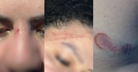 Mulher que levou tapa de PM em Florianópolis mostra hematomas: 'Chegaram jogando spray de pimenta'